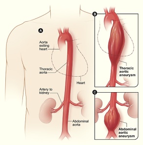 A. Aorta nomală B. Anevrism de aortă toracică descendetă C. Anevrism de aortă abdominală, sub originea arterelor renale