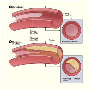 sus:arteră normală jos: arteră cu placă de ateroscleroză realizând o stenoză