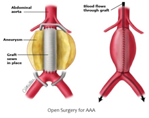 Aorta abdominală cu anevrismul deschis și înlocuit cu o proteză prin chirurgie clasică